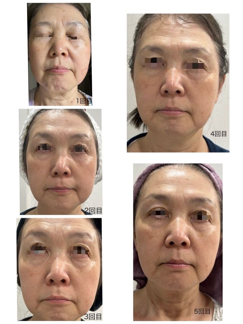 REVI 陶肌トリートメント フルオプションセット1回分