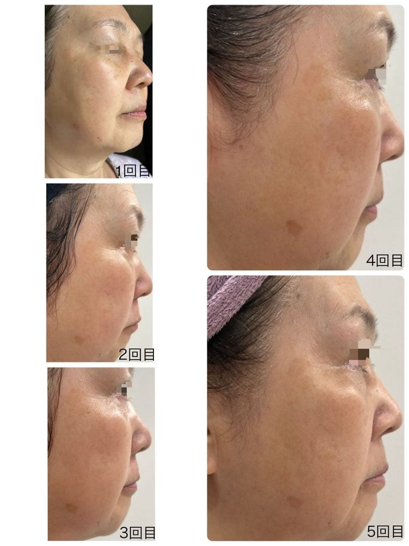 REVI 陶肌トリートメント フルオプションセット1回分