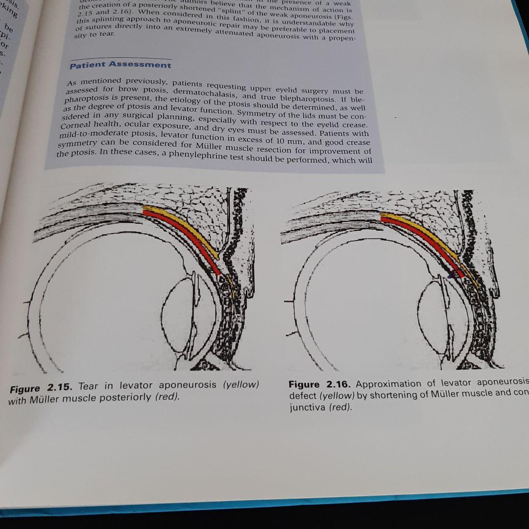美容眼瞼下垂手術テキスト（英語版）