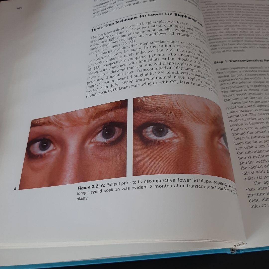 美容眼瞼下垂手術テキスト（英語版）