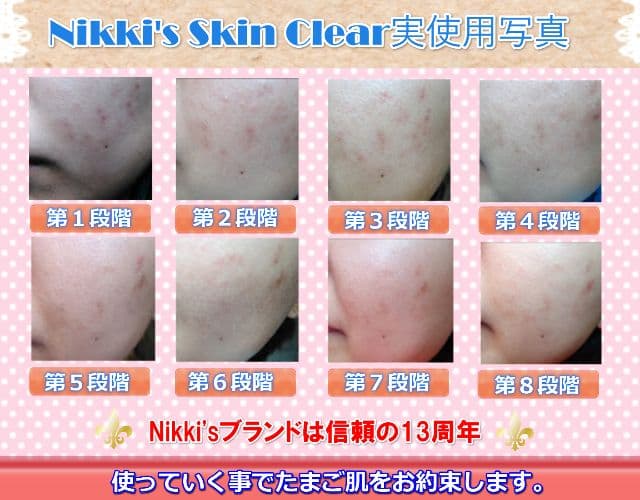ニキビ跡、毛穴、しみ、そばかす　噂のNikki's Skin Clear 通常版