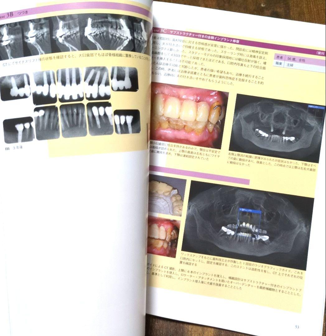インプラントレストレーション vol. III
