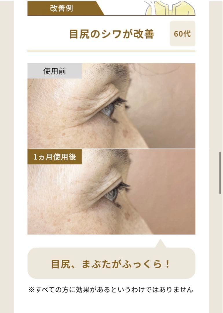 【最終価格・残り2点】新品ナリスSELGRACE I+II セット*2最高峰エイ