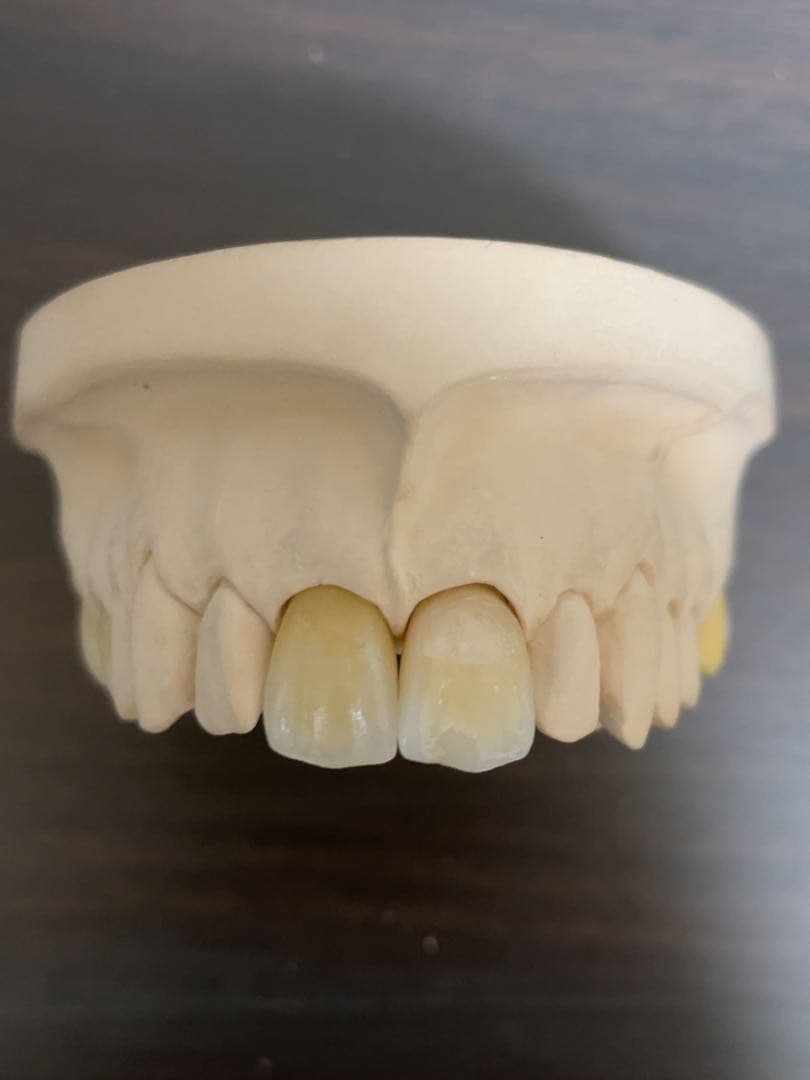 歯科技工　イーマックスサンプル模型　65116 歯科医院などのサンプルに！