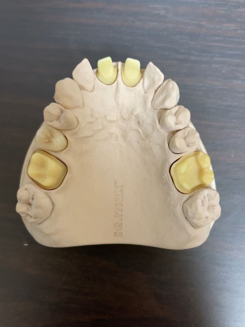 歯科技工　イーマックスサンプル模型　65116 歯科医院などのサンプルに！