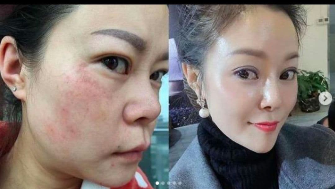 RENECELL ルネセル　基礎6点セット