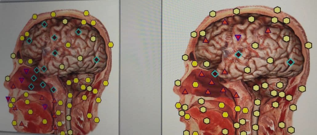 期間限定セール★波動測定器18D NLS メタトロン ニュースキャンヒーリング