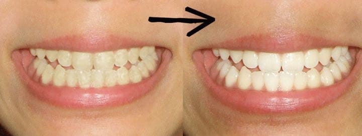 キラビアンカ ホワイトニングジェル