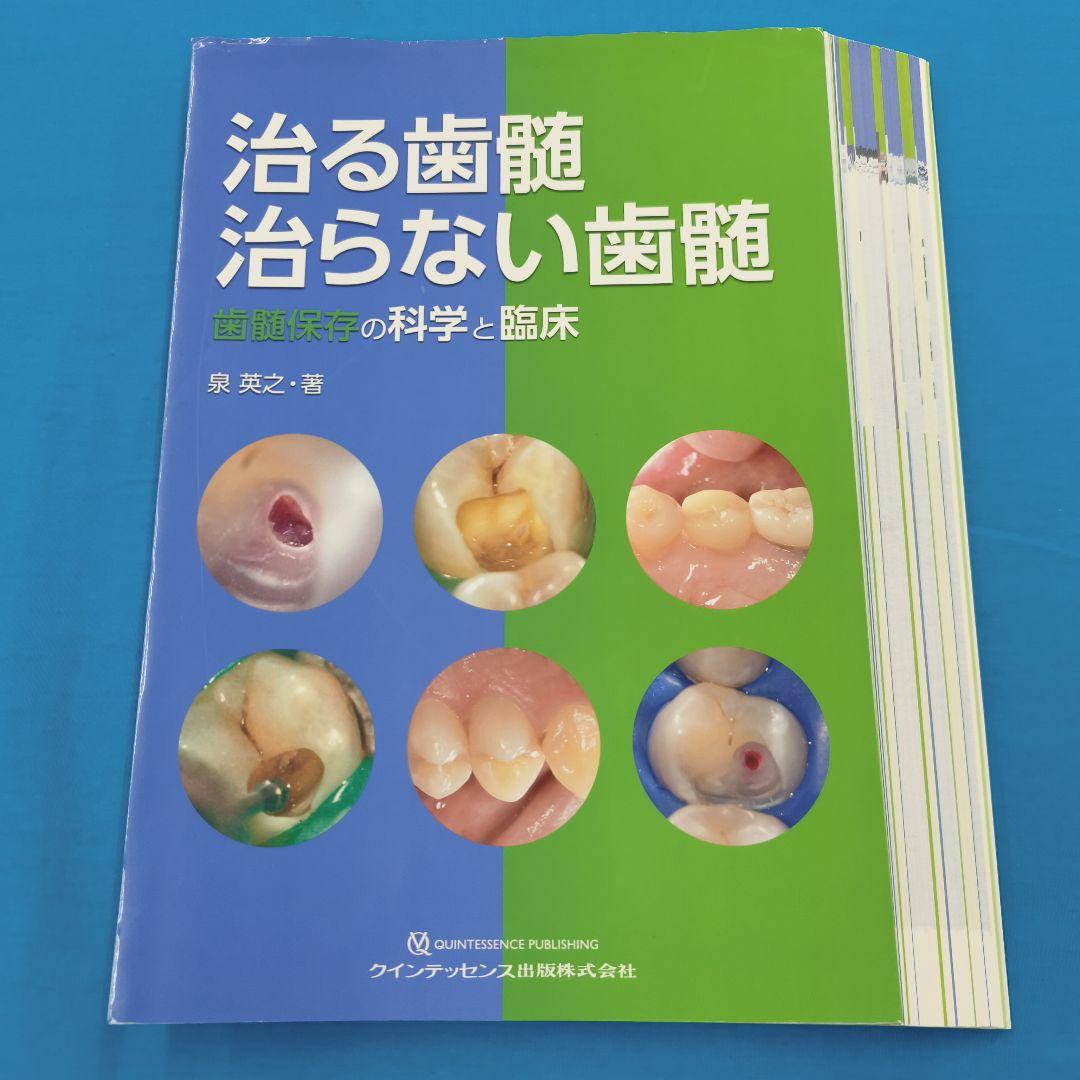 ♣裁断済 治る歯髄 治らない歯髄