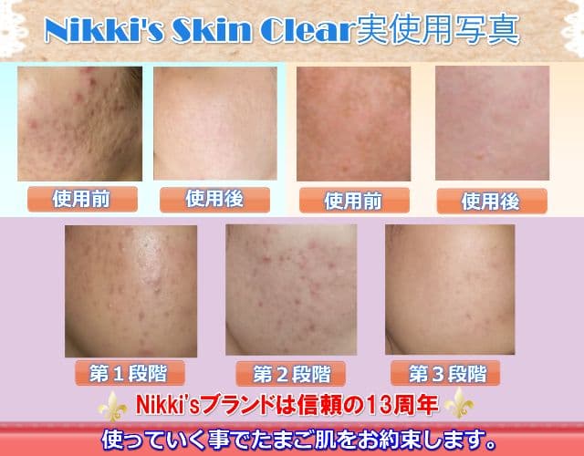 ニキビ跡、毛穴、しみ、そばかす　噂のNikki's Skin Clear　通常用