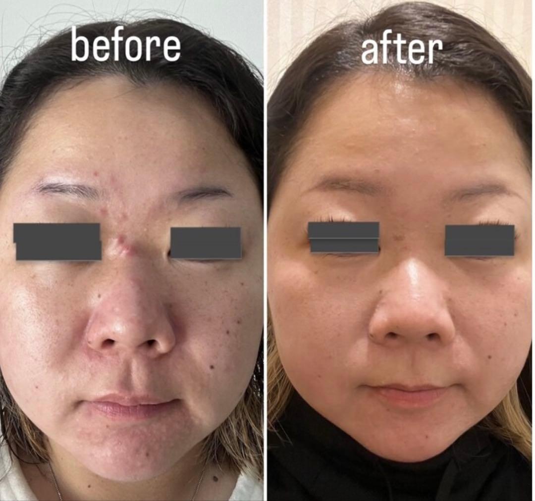 ハーブピーリング 剥離あり　皮剥けあり　8-9回分→9g