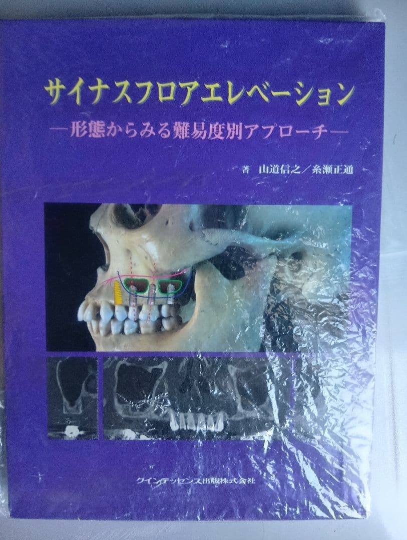 サイナスフロアエレベーション