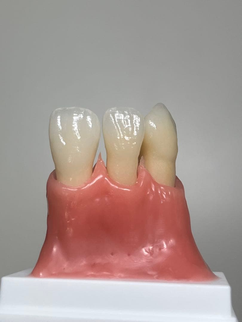 歯科 セラミックサンプル 擬似歯肉付き