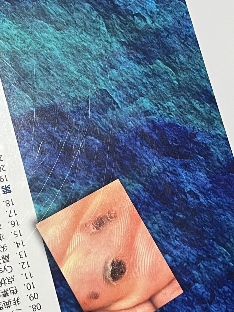 疣贅(いぼ)のみかた、治療のしかた