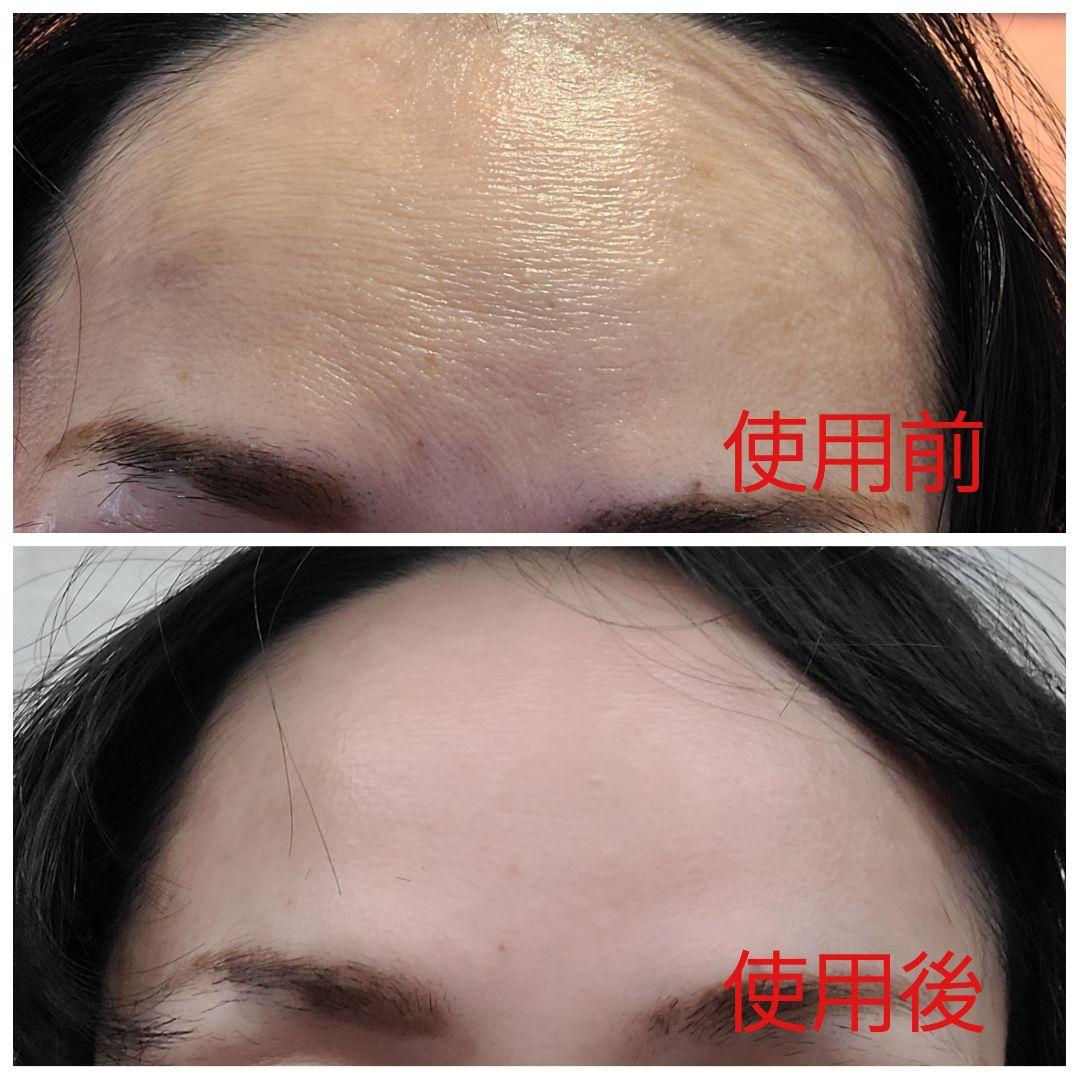 ヴィジョン・ド・ボーテ12個セット塗るボトックスおでこや目尻のシワに